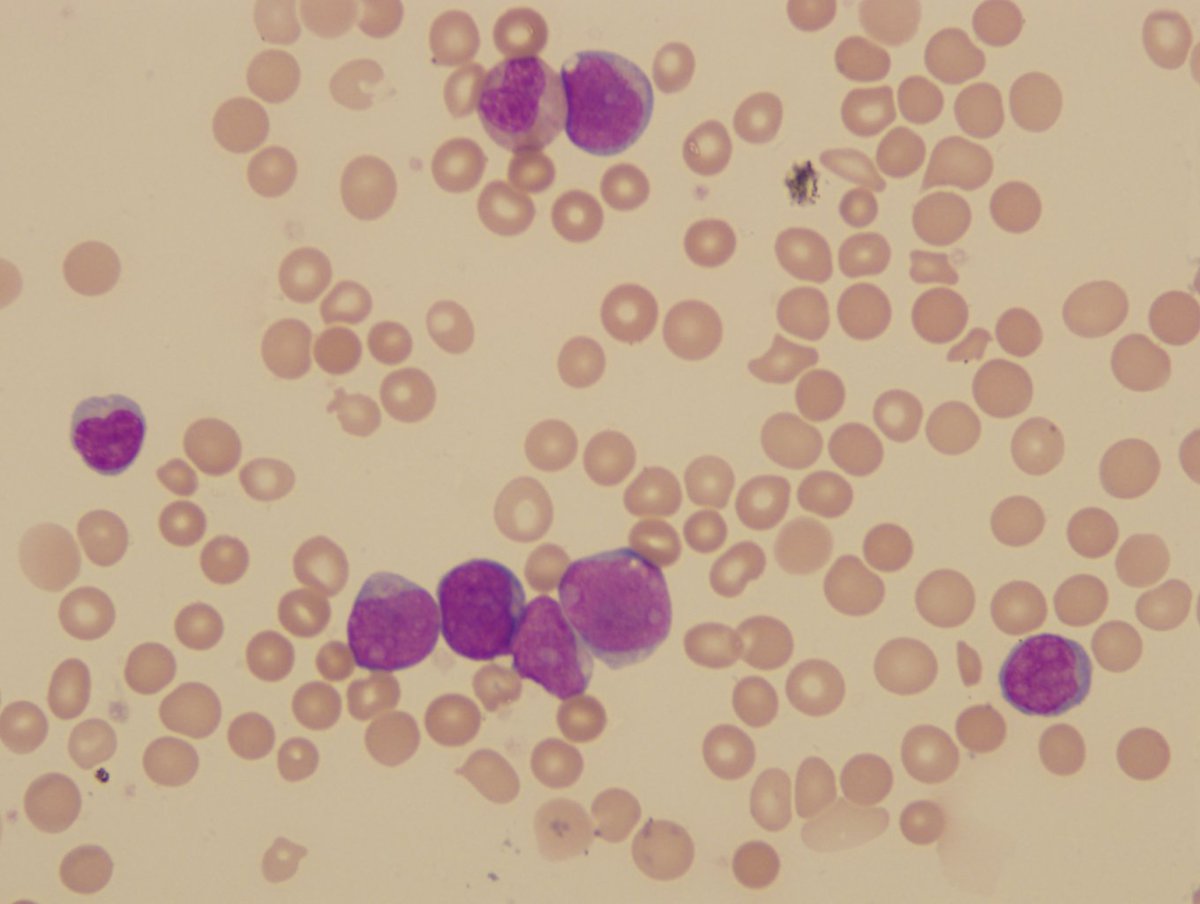 Figure 2-3. The blasts in peripheral blood smear at day 45 of patient with DS